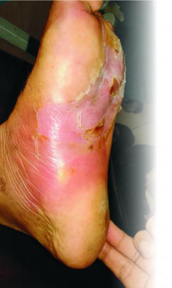 Ayurvedic Management of Diabetic Foot